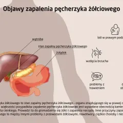 Ilustracja przedstawia anatomię wątroby, żołądka i pęcherzyka żółciowego, obok ikon objawów zapalenia pęcherzyka żółciowego, takich jak ból, wzdęcia, wymioty i problemy z trawieniem, wskazując na cholestazę.