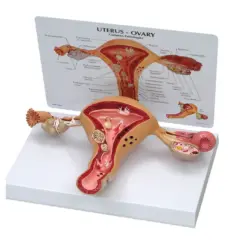 Model anatomiczny narządu rodnego kobiety z widoczną torbielą na jajniku.