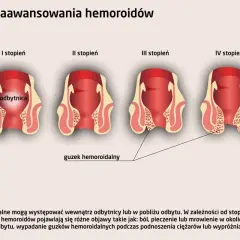 Ilustracja przedstawia cztery stopnie zaawansowania hemoroidów wewnętrznych, od I do IV, pokazując ich umiejscowienie i powiększanie się guzków.