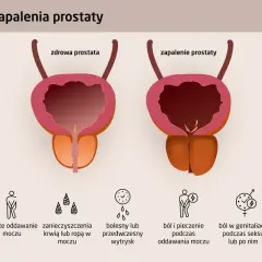 Porównanie zdrowej i zapalonej prostaty. Objawy zapalenia gruczołu krokowego obejmują problemy z oddawaniem moczu i bóle.