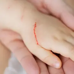 Dziecko ma zadrapanie na dłoni, które może być objawem choroby kociego pazura.