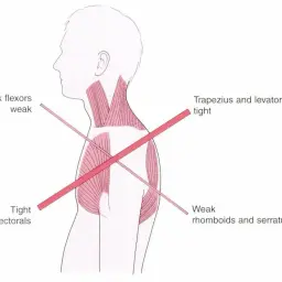 Anatomia mięśnia czworobocznego: napięty górny, osłabiony dolny. Napięte piersiowe, osłabione głębokie zginacze szyi.