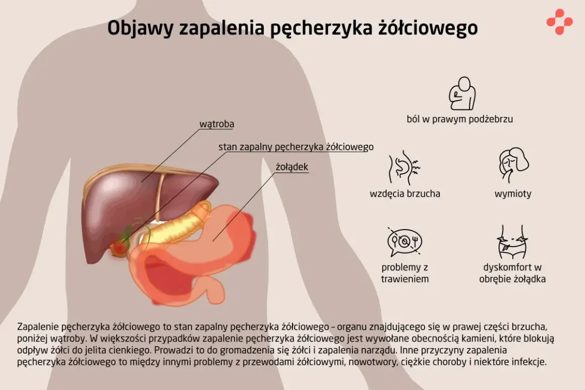 Ilustracja przedstawia anatomię wątroby, żołądka i pęcherzyka żółciowego, obok ikon objawów zapalenia pęcherzyka żółciowego, takich jak ból, wzdęcia, wymioty i problemy z trawieniem, wskazując na cholestazę.