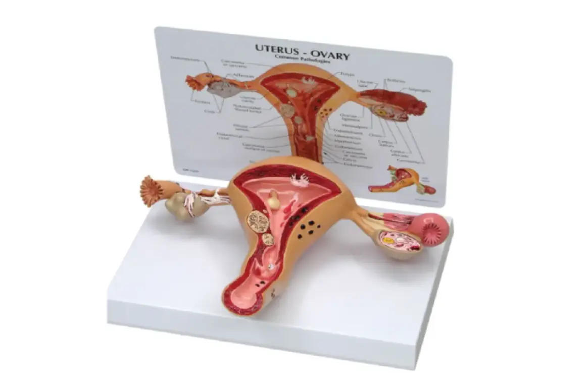 Model anatomiczny narządu rodnego kobiety z widoczną torbielą na jajniku.