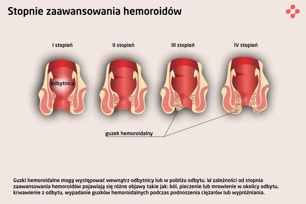 Hemoroidy wewnętrzne - objawy, leczenie i sygnały alarmowe
