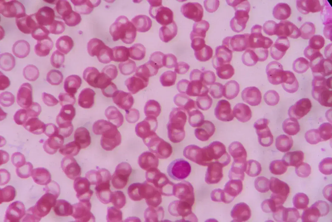 Podwyższone RDW i anizocytoza - co oznaczają?
