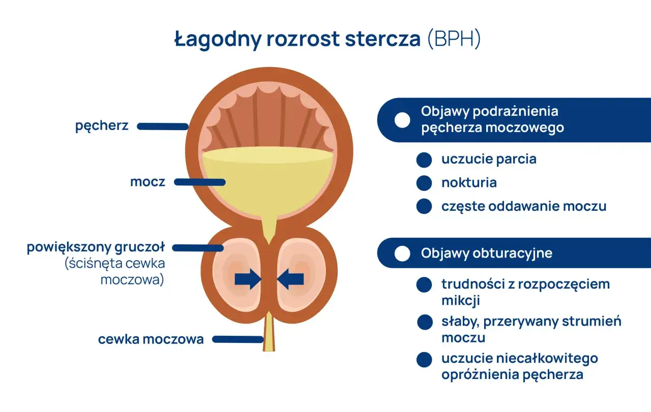 Ilustracja przedstawia łagodny rozrost stercza (BPH), gdzie powiększony gruczoł uciska cewkę moczową, powodując objawy podrażnienia i obturacji pęcherza.
