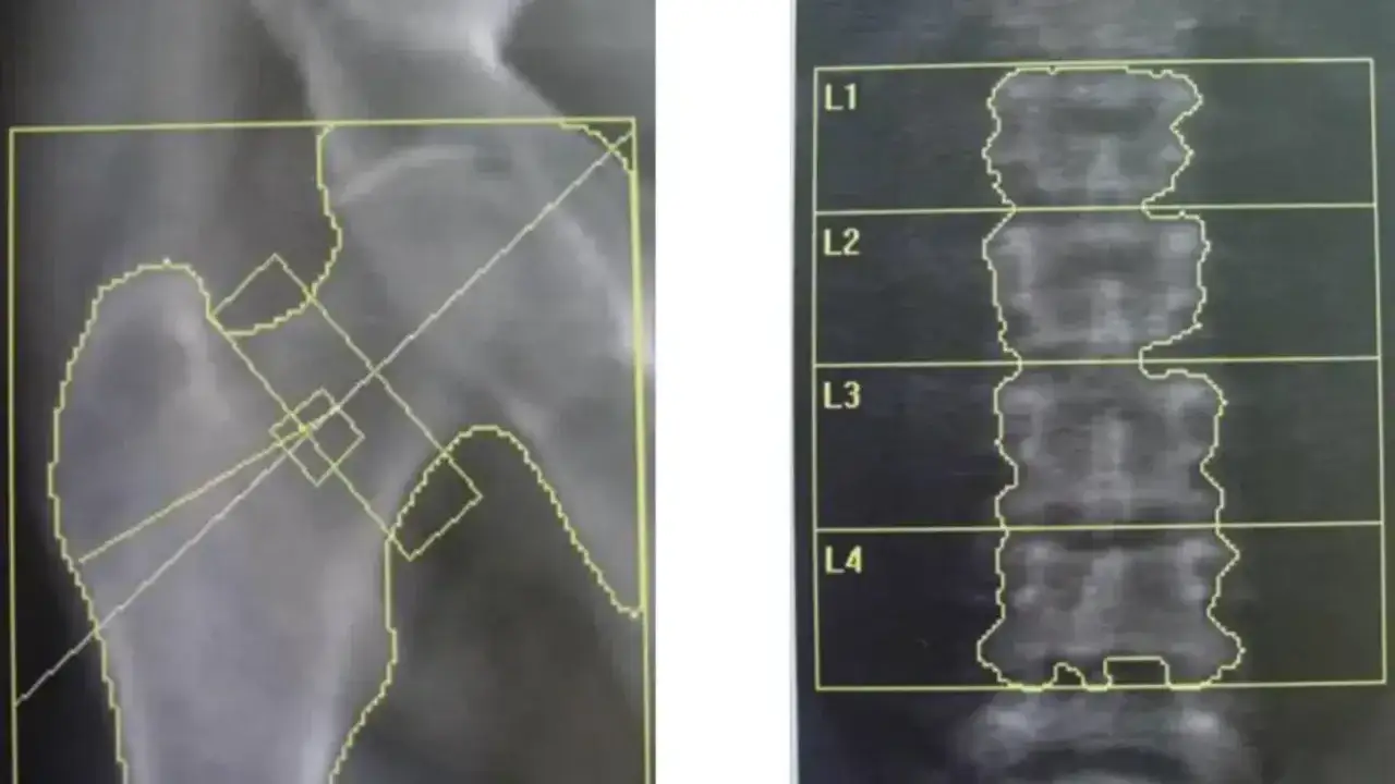 Rentgen biodra i kręgosłupa z zaznaczonymi obszarami do analizy gęstości kości, co może pomóc w diagnostyce osteopenii.