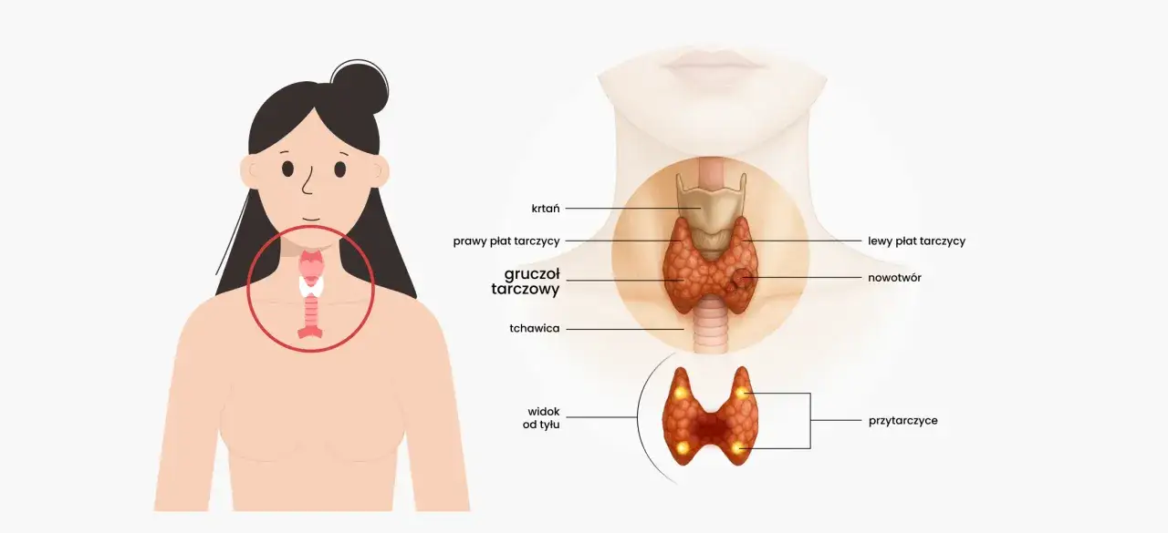 Anatomia tarczycy z zaznaczonym nowotworem. Czy tarczyca może boleć? Ilustracja pokazuje gruczoł tarczowy, krtań, tchawicę i przytarczyce.