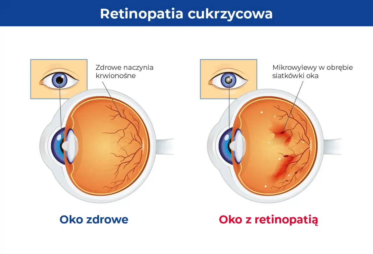 Porównanie oka zdrowego z naczyniami krwionośnymi siatkówki i oka z retinopatią cukrzycową, gdzie widoczne są mikrowylewy.