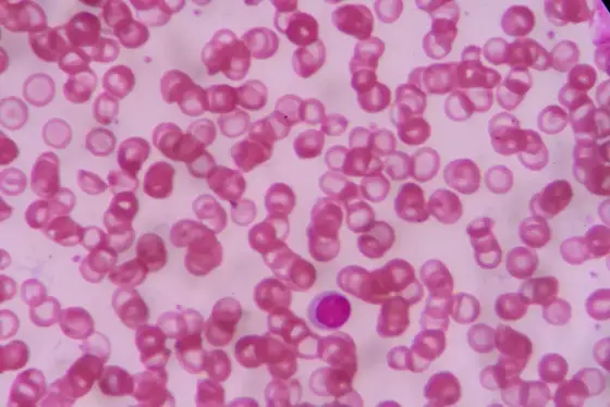 Podwyższone RDW i anizocytoza - co oznaczają?