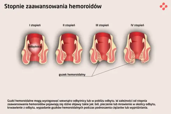 Hemoroidy wewnętrzne - objawy, leczenie i sygnały alarmowe